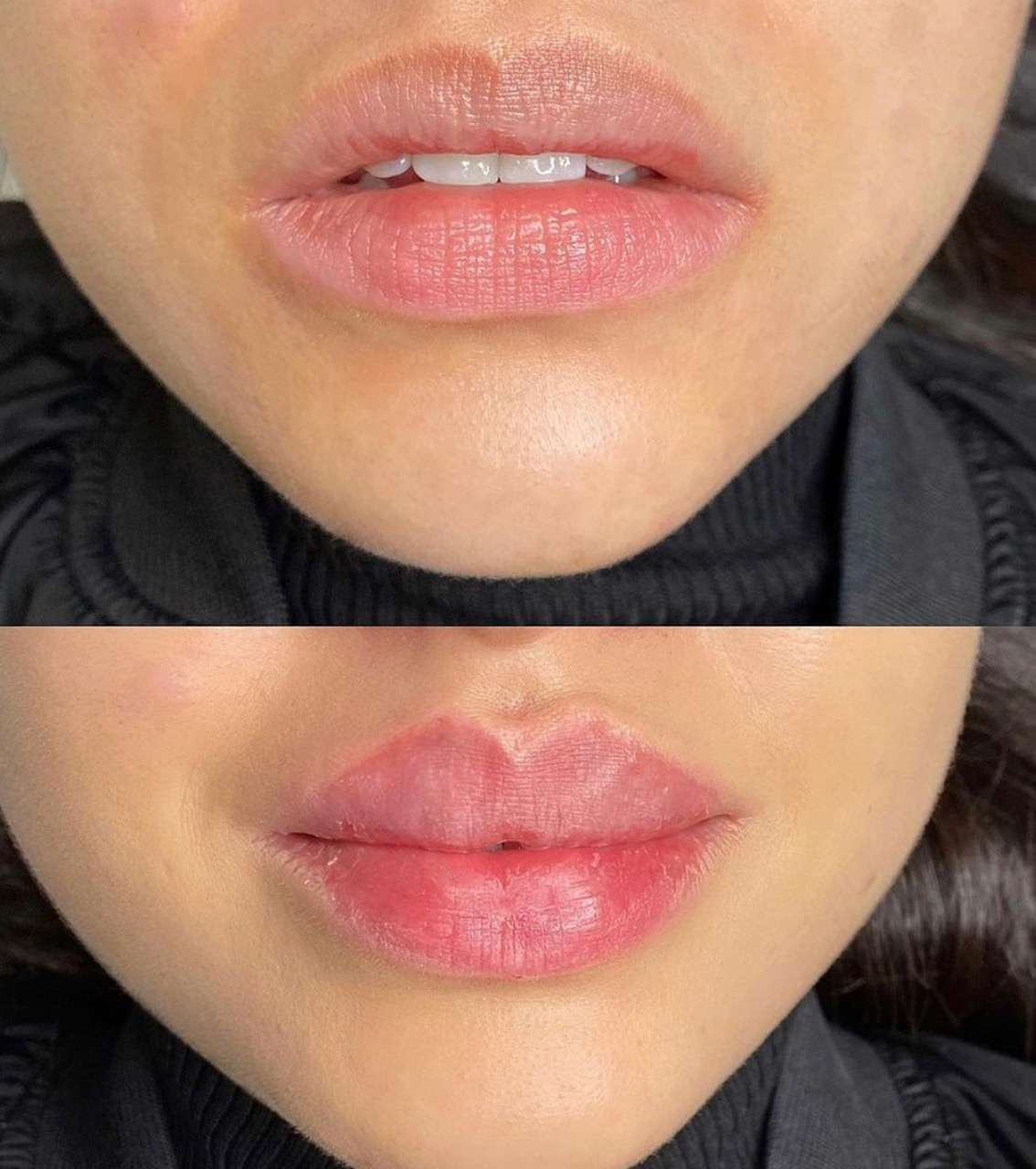 Lippen aufspritzen SW BeautyBar Zürich