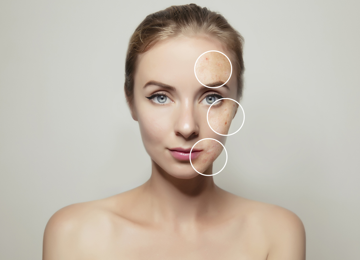 Vampirlifting Akne Detaillierte Infos