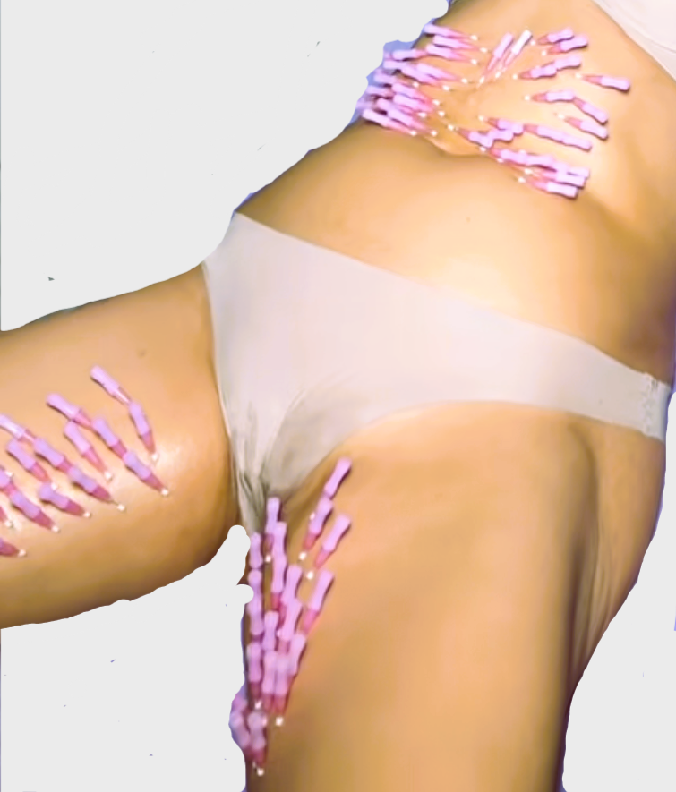Fadenlifting Bauch, Beine Bild