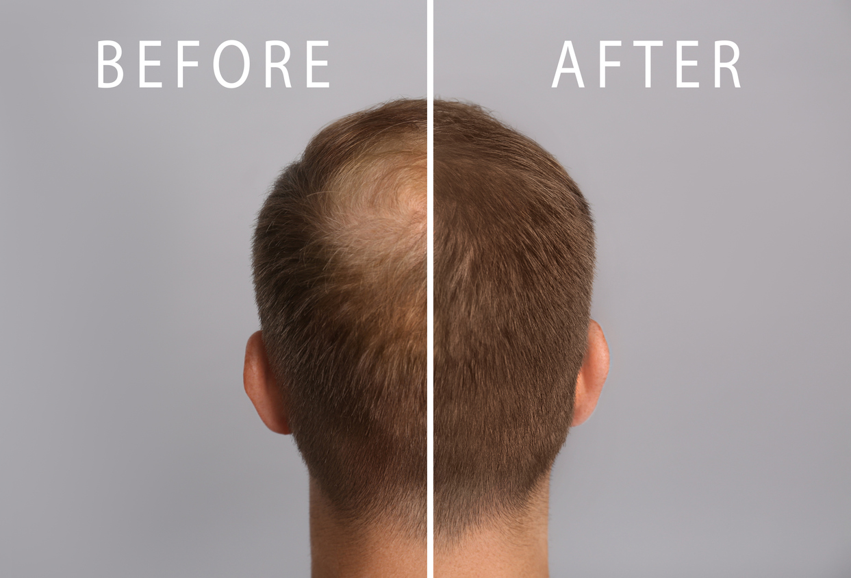 Detaillierte Informationen Vampirlifting Haarausfall /Haarwachstum