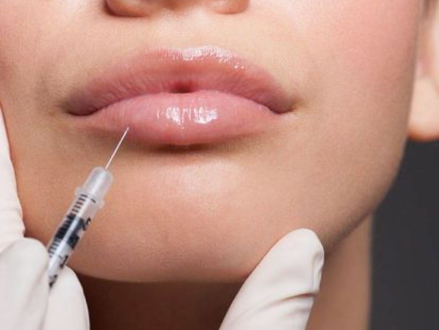 Details zu Botox Lip Flip